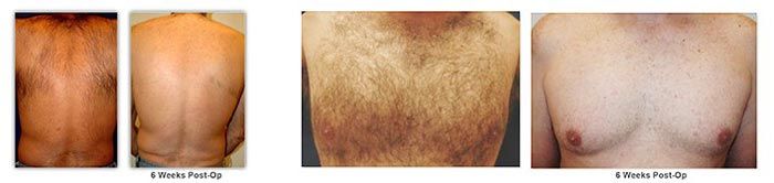 Post-operative chest results after six weeks.