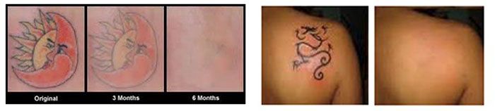 Tattoo fading progression over six months.