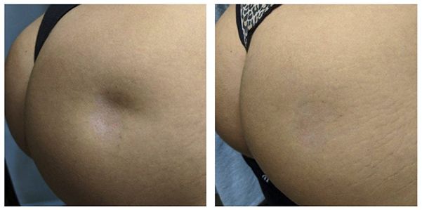 Before and after skin texture comparison.