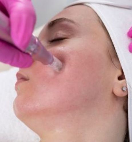 RF Microneedling At Wellness Center of Greater Cleveland, OH