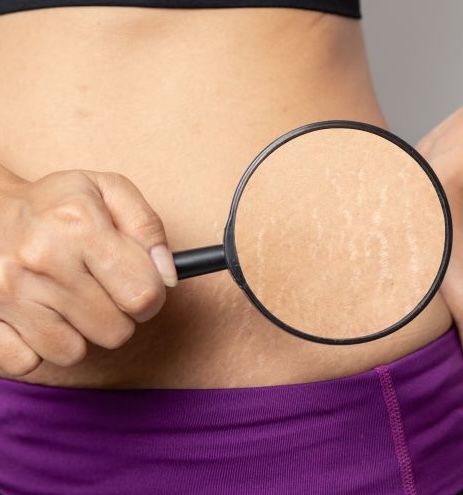 Stretch Marks At Wellness Center of Greater Cleveland, OH
