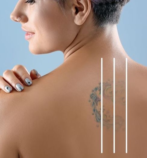 Tattoo Removal At Wellness Center of Greater Cleveland, OH