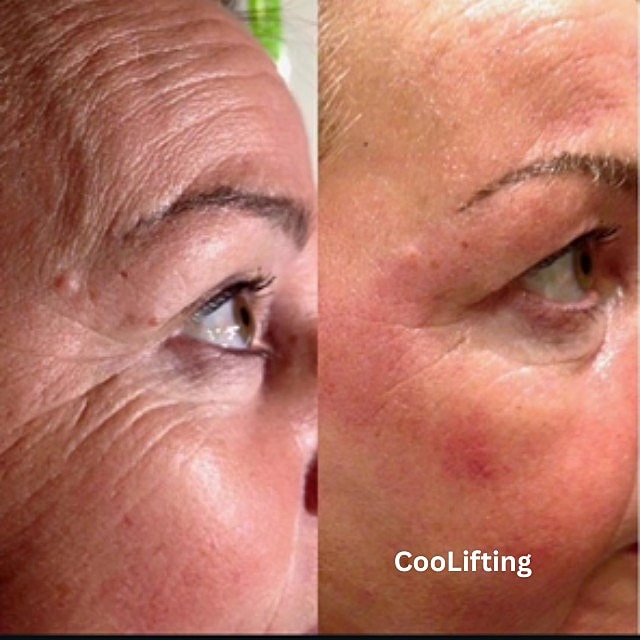 Cool Lifting Before & After