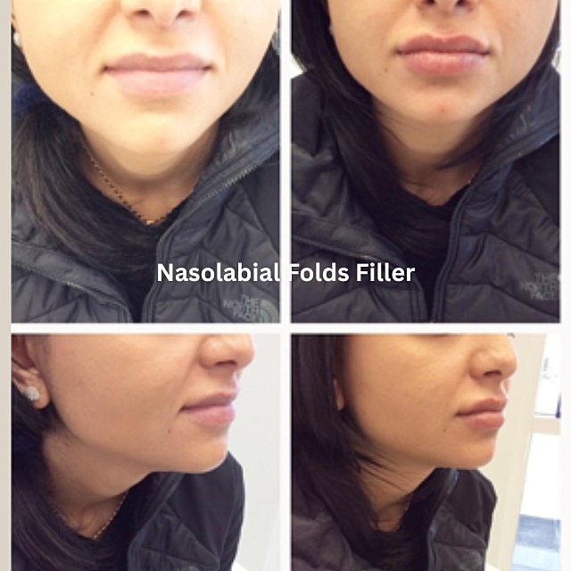 Nasolabial Folds Filler Before & After