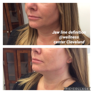 Jawline Filler Before & After