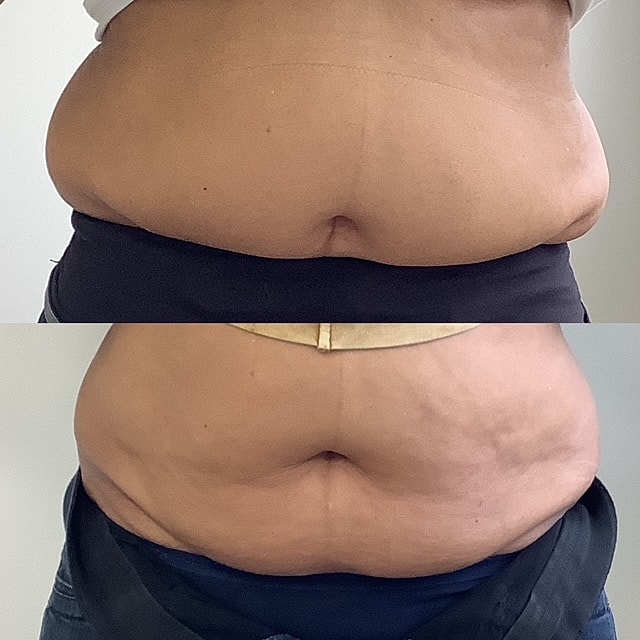 Vanquish ME Before & After