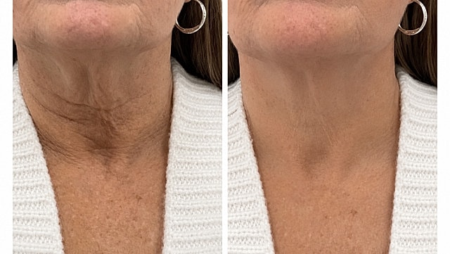 Laser & Energy Before & After