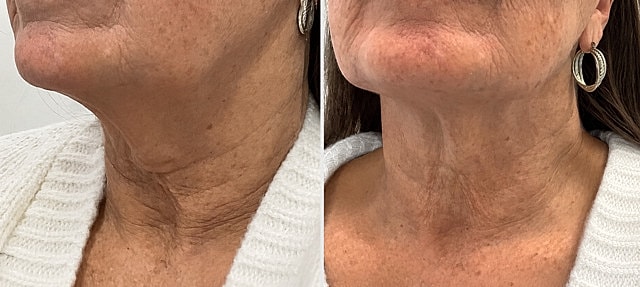 Laser & Energy Before & After