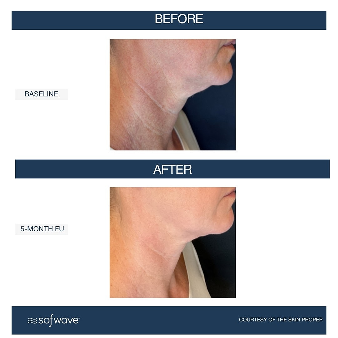 Laser & Energy Before & After
