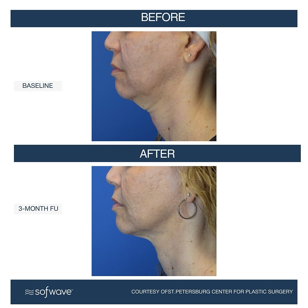 Laser & Energy Before & After