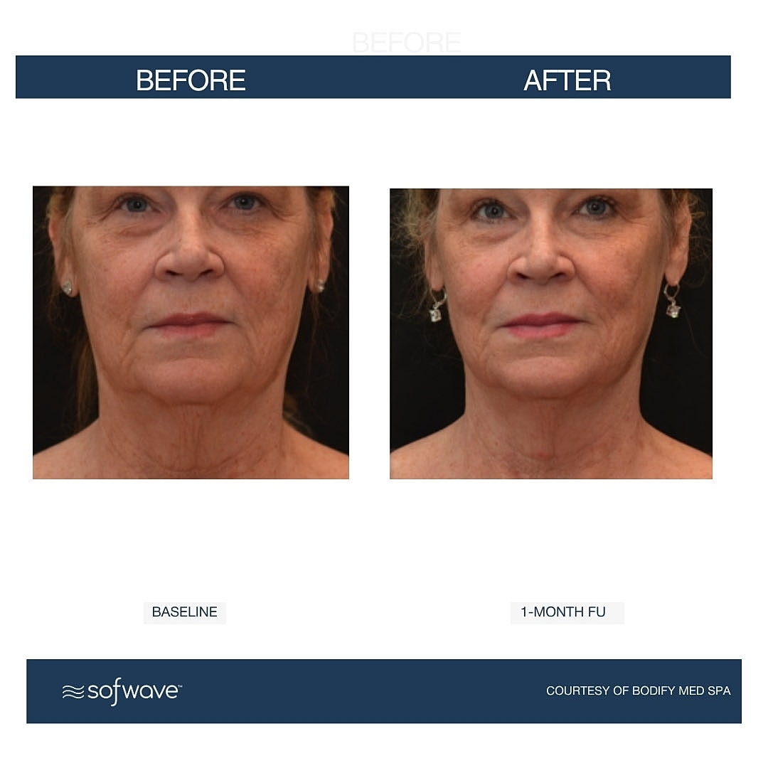 Laser & Energy Before & After