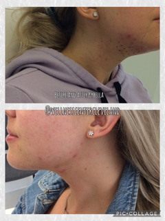 Kybella Before & After