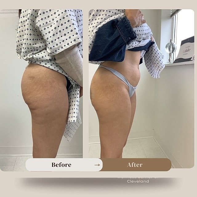 Aveli Before & After