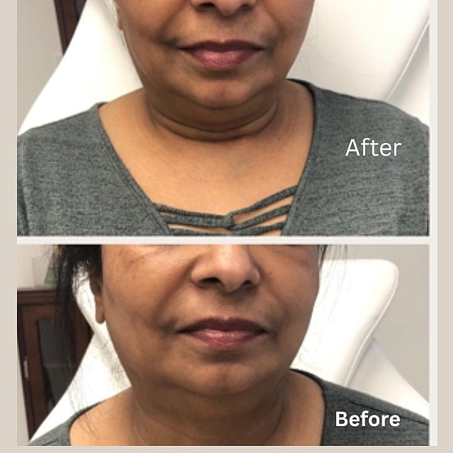 PDO Threads Before & After