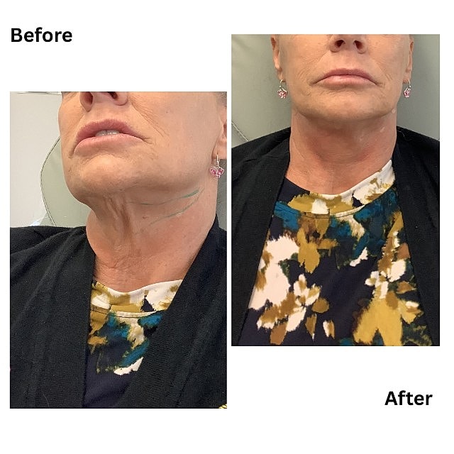 PDO Threads Before & After