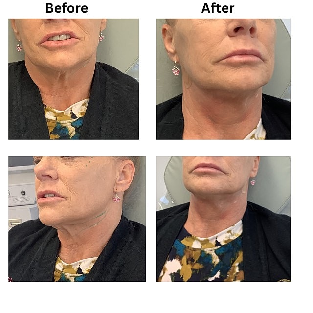 PDO Threads Before & After