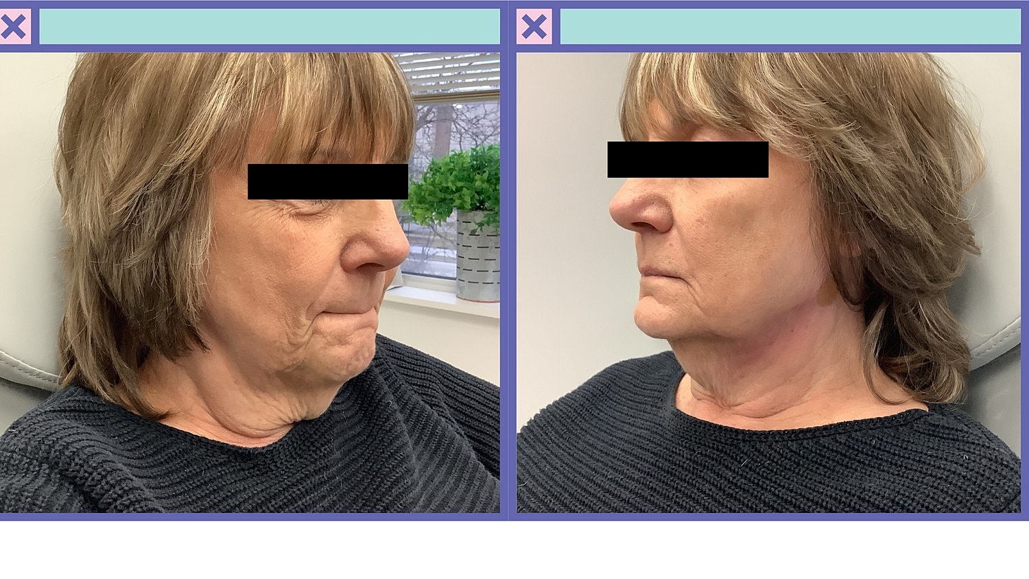 PDO Threads Before & After