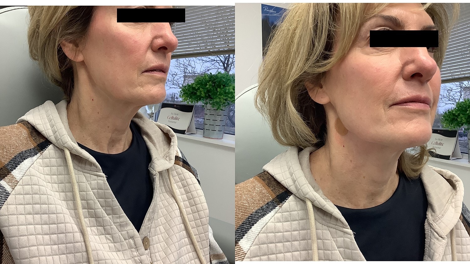 PDO Threads Before & After