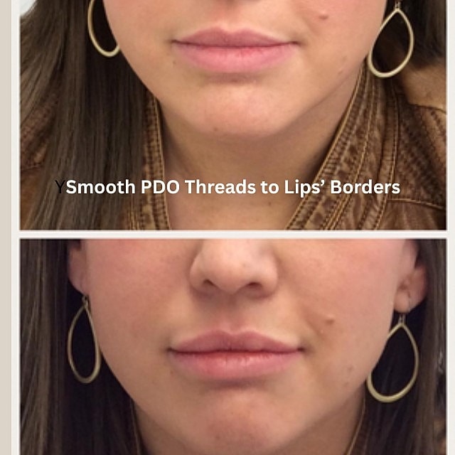 PDO Threads Before & After