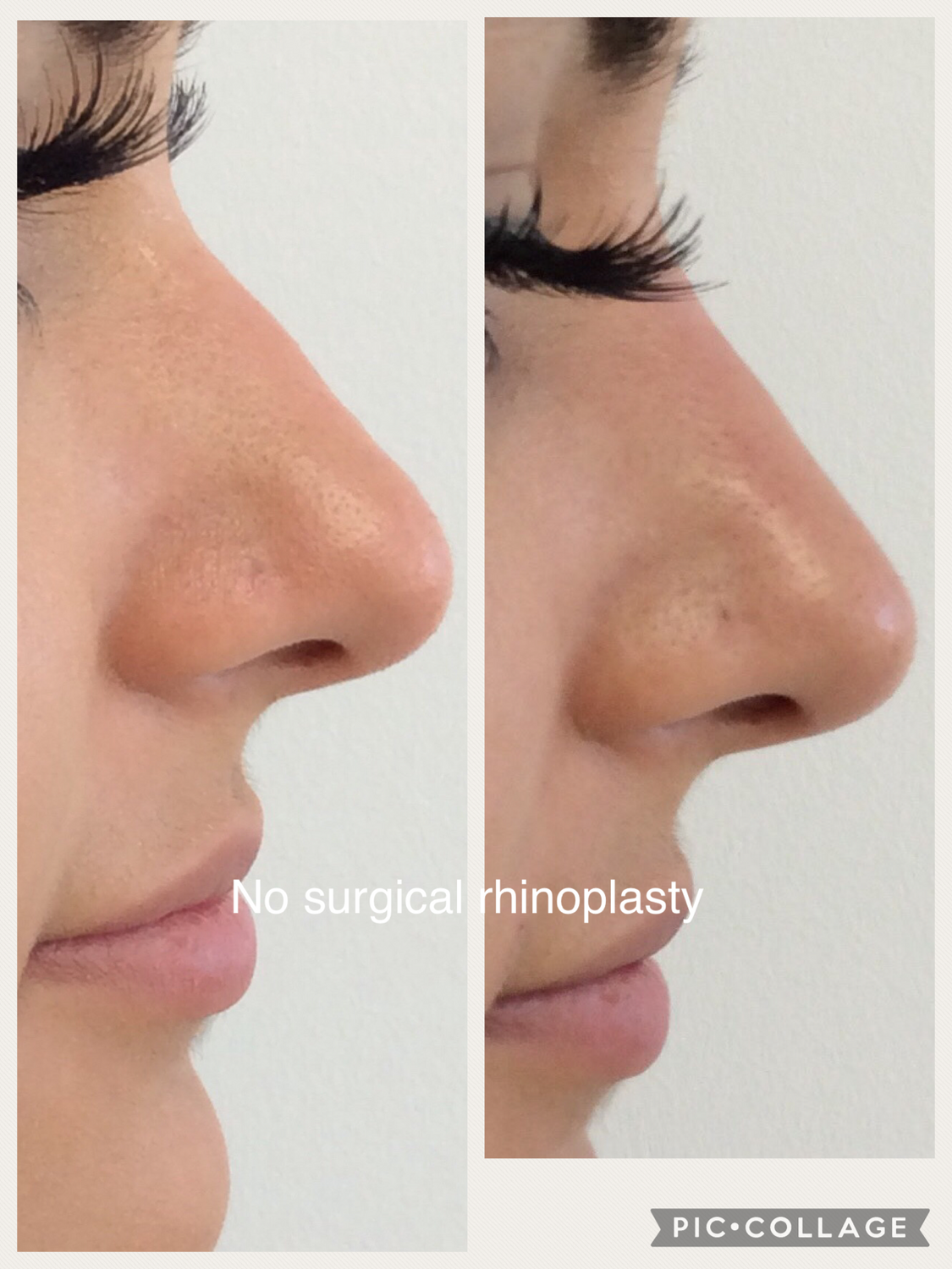 Non-Surgical Rhinoplasty Before & After