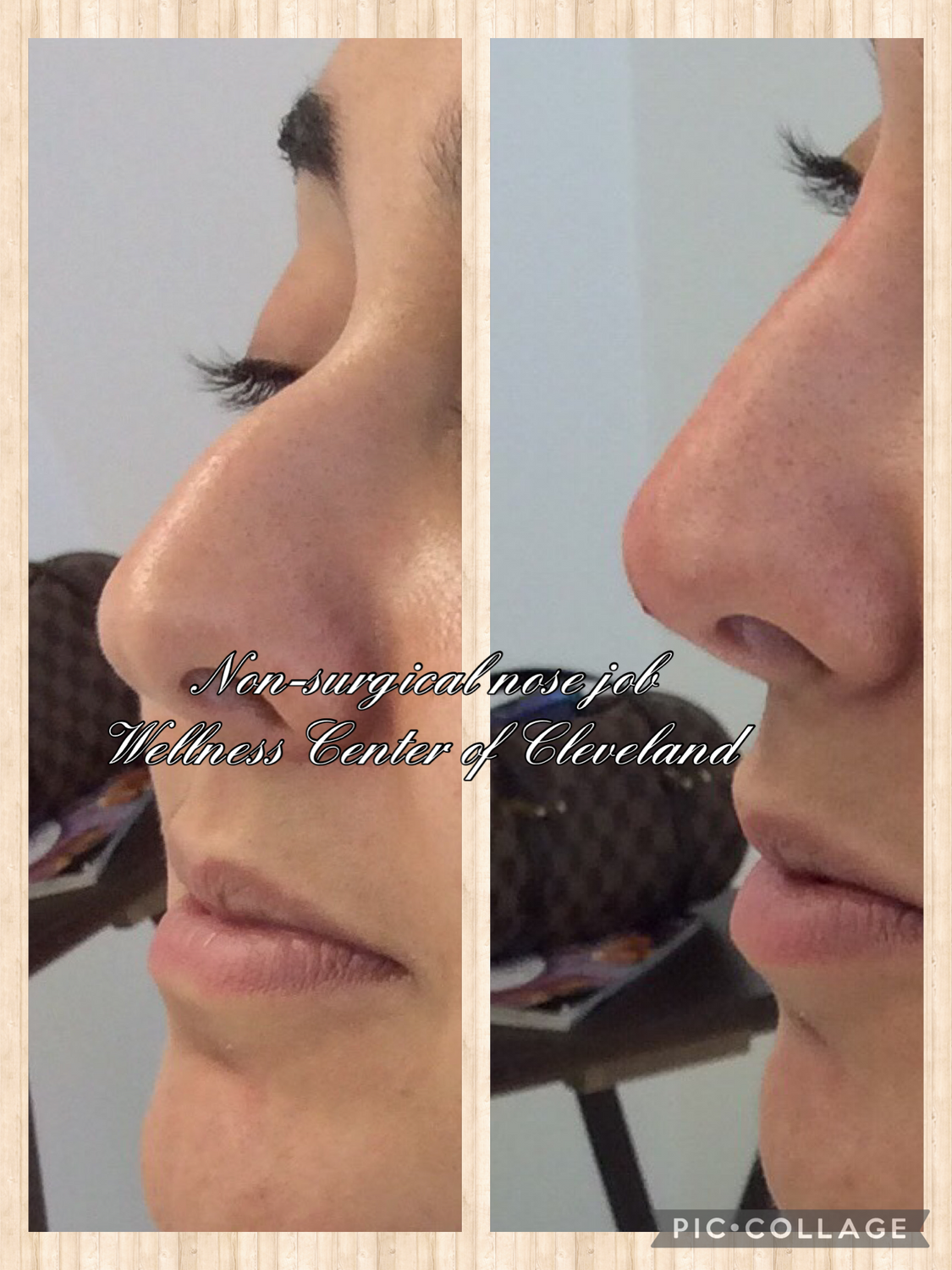 Non-Surgical Rhinoplasty Before & After