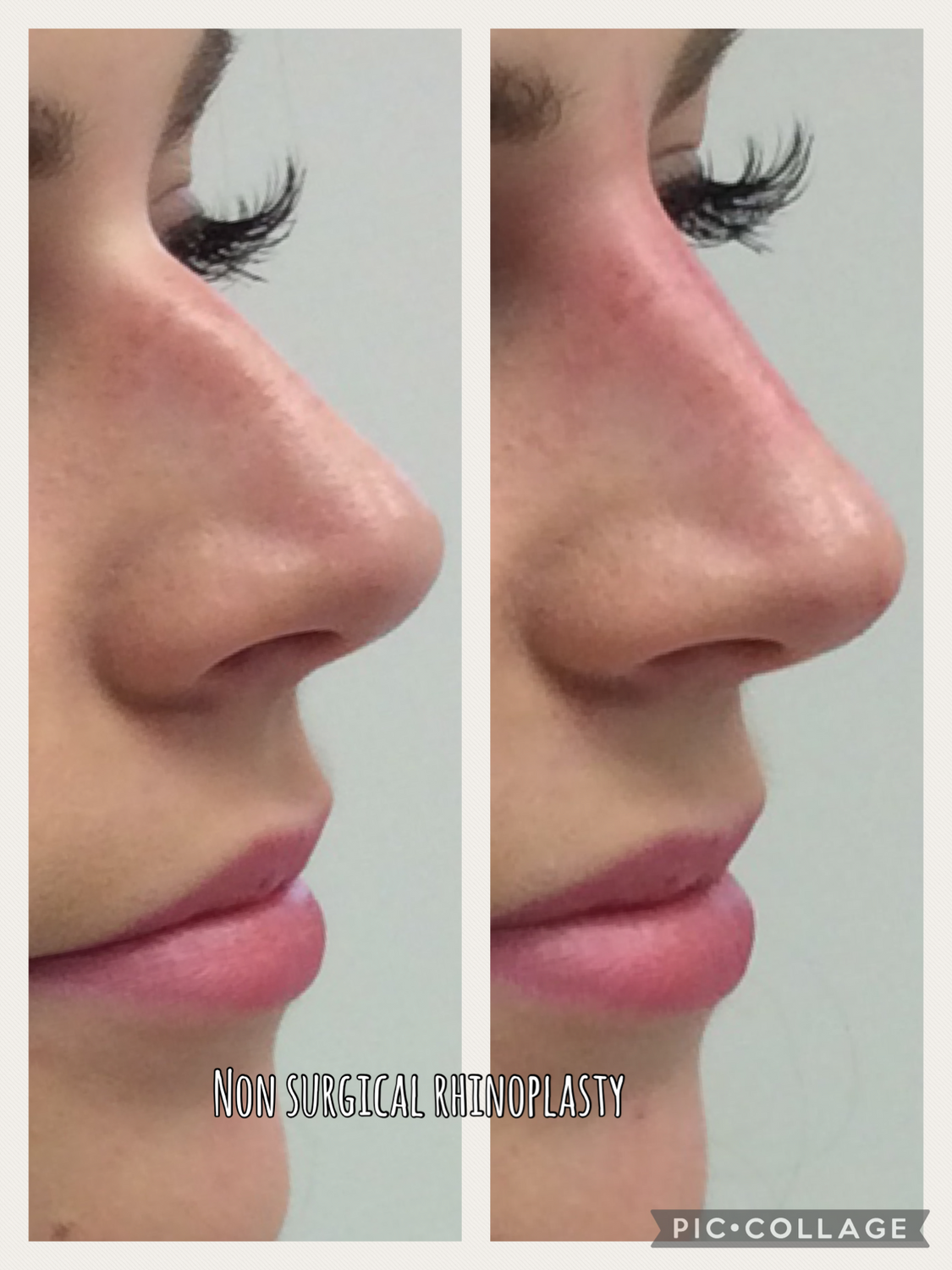 Non-Surgical Rhinoplasty Before & After