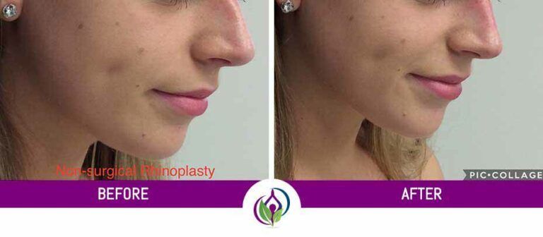 Non-Surgical Rhinoplasty Before & After