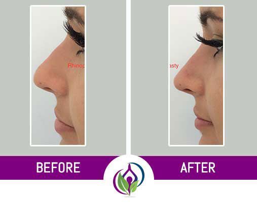 Non-Surgical Rhinoplasty Before & After