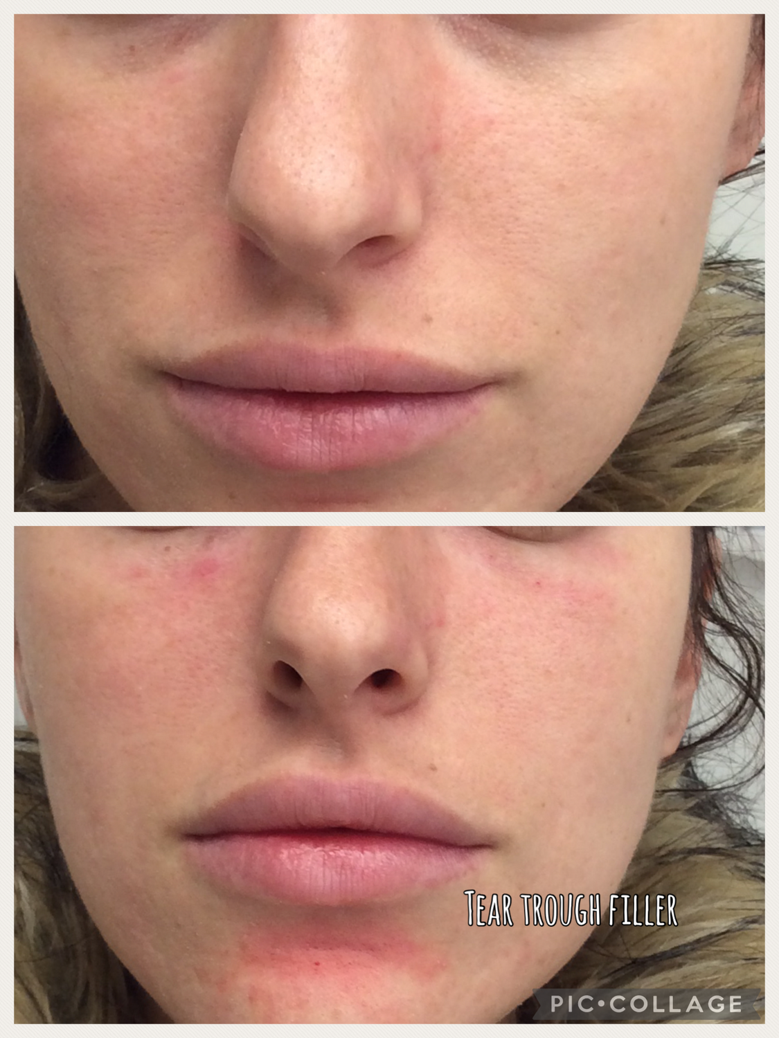 Tear Trough Filler Before & After