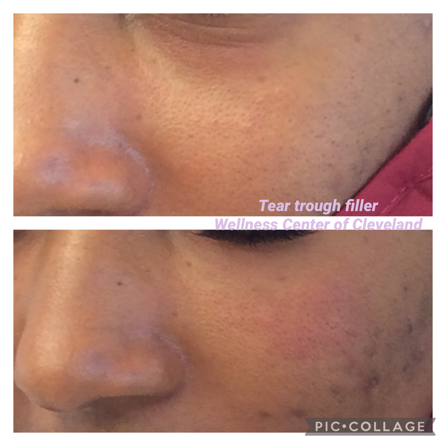 Tear Trough Filler Before & After