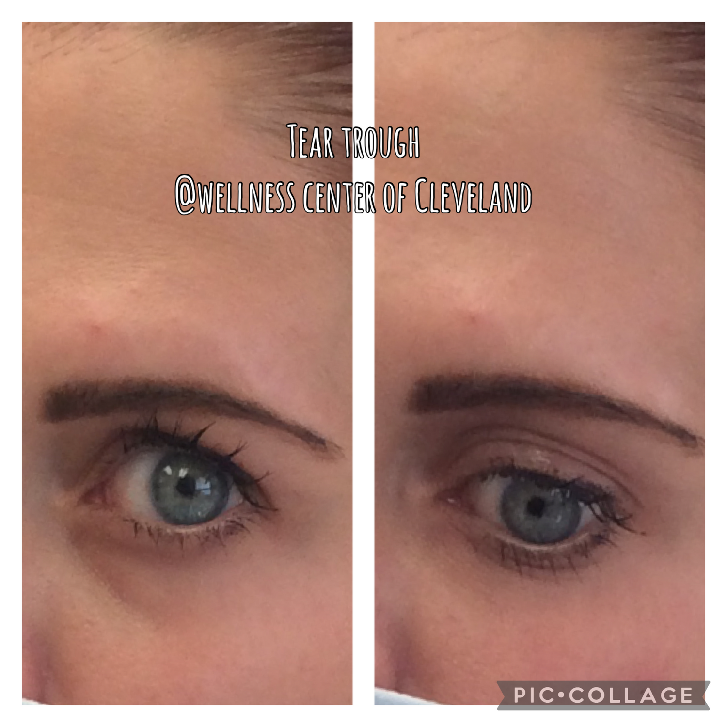 Tear Trough Filler Before & After