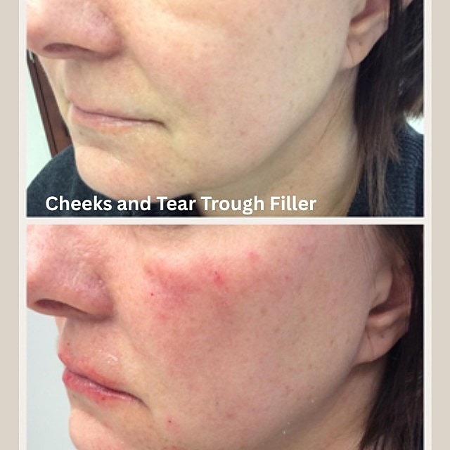 Tear Trough Filler Before & After