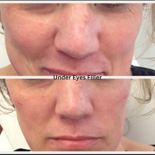 Tear Trough Filler Before & After