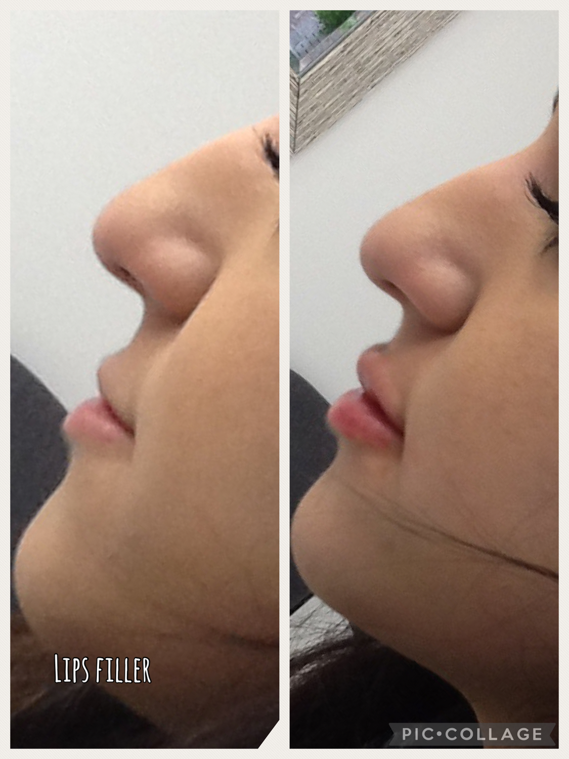 Before and After Photos Before & After