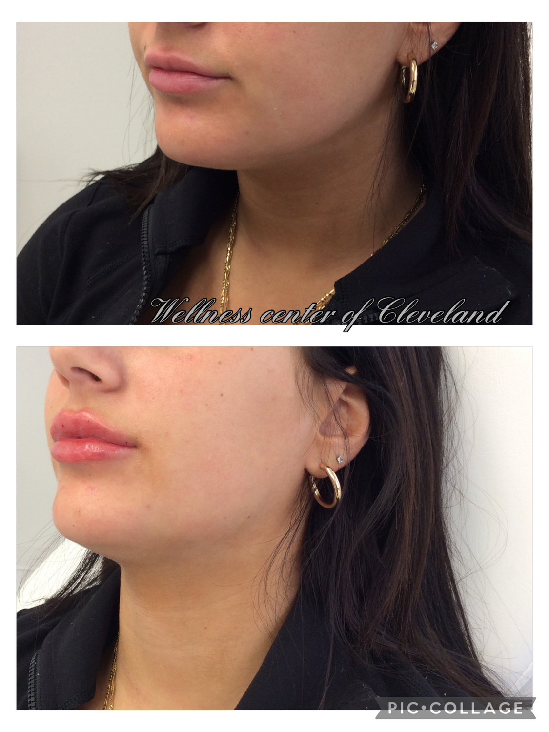 Before and After Photos Before & After