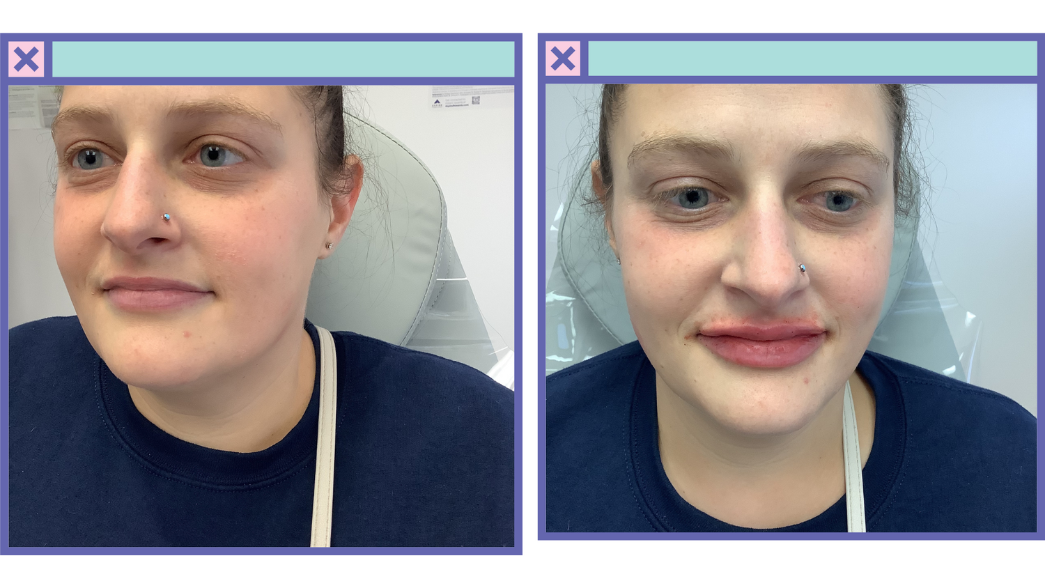 Lip Filler Before & After