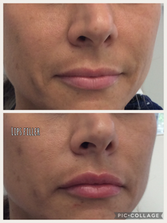 Before and After Photos Before & After