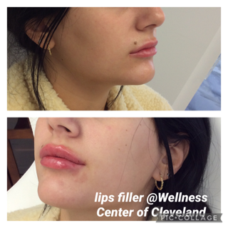 Before and After Photos Before & After