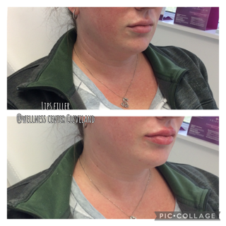 Before and After Photos Before & After