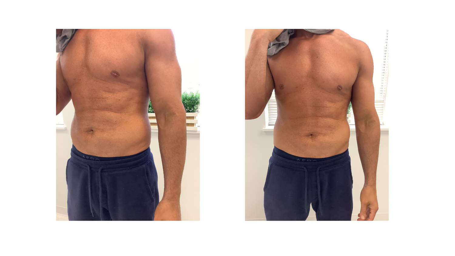 Emsculpt Before & After