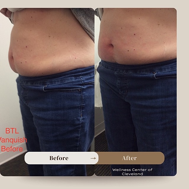 Emsculpt Before & After