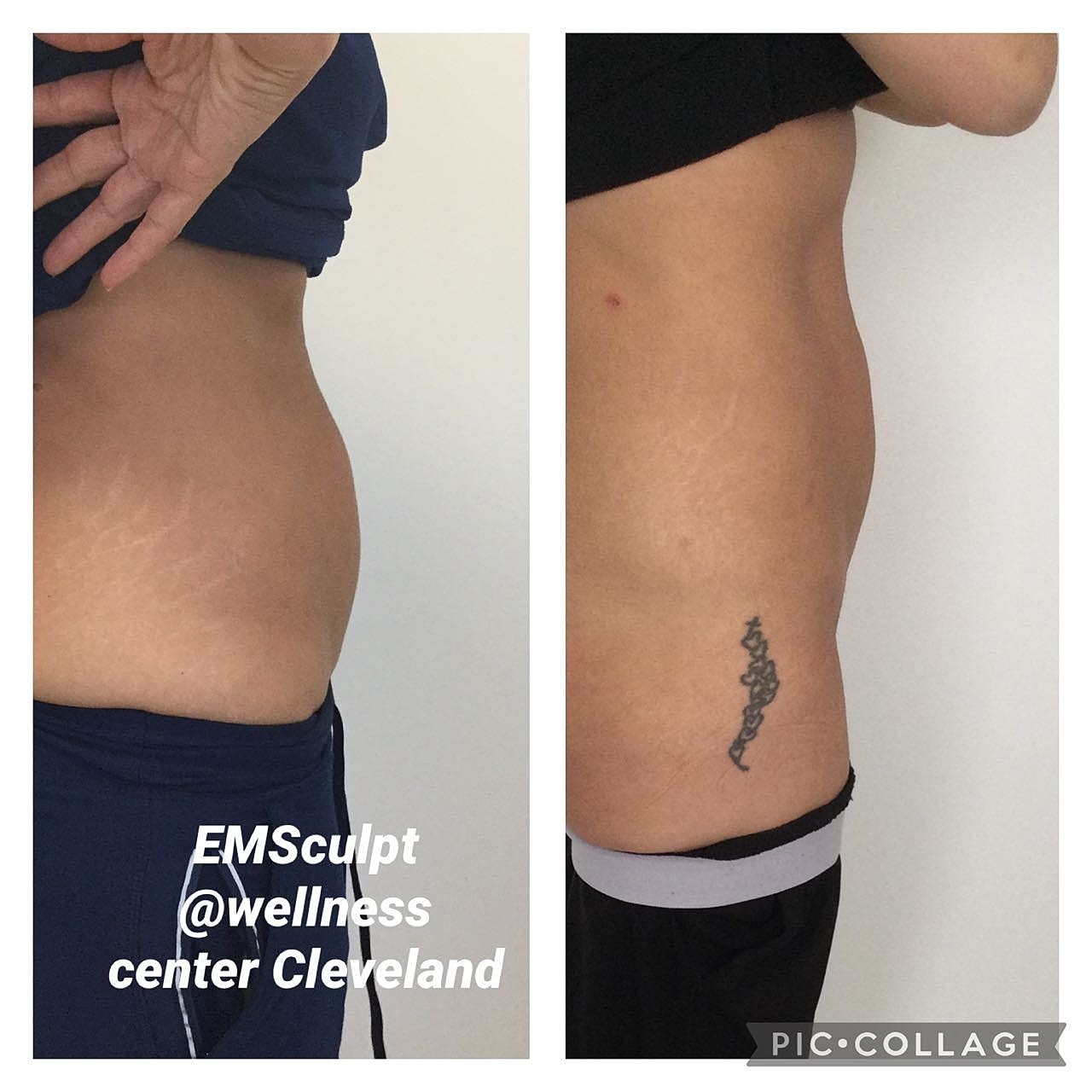 Emsculpt Before & After