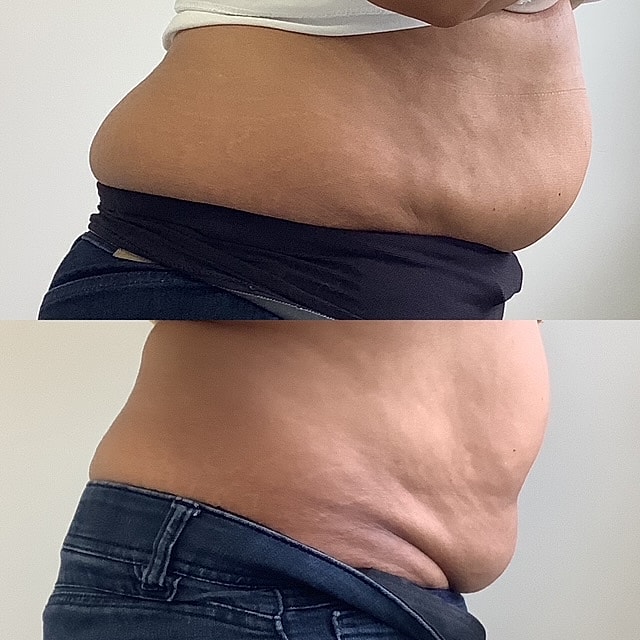 Emsculpt Before & After