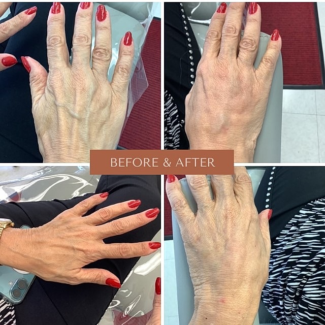 Renuva Before & After