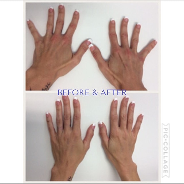 Hand Filler Before & After