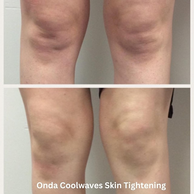 Onda Coolwave Before & After