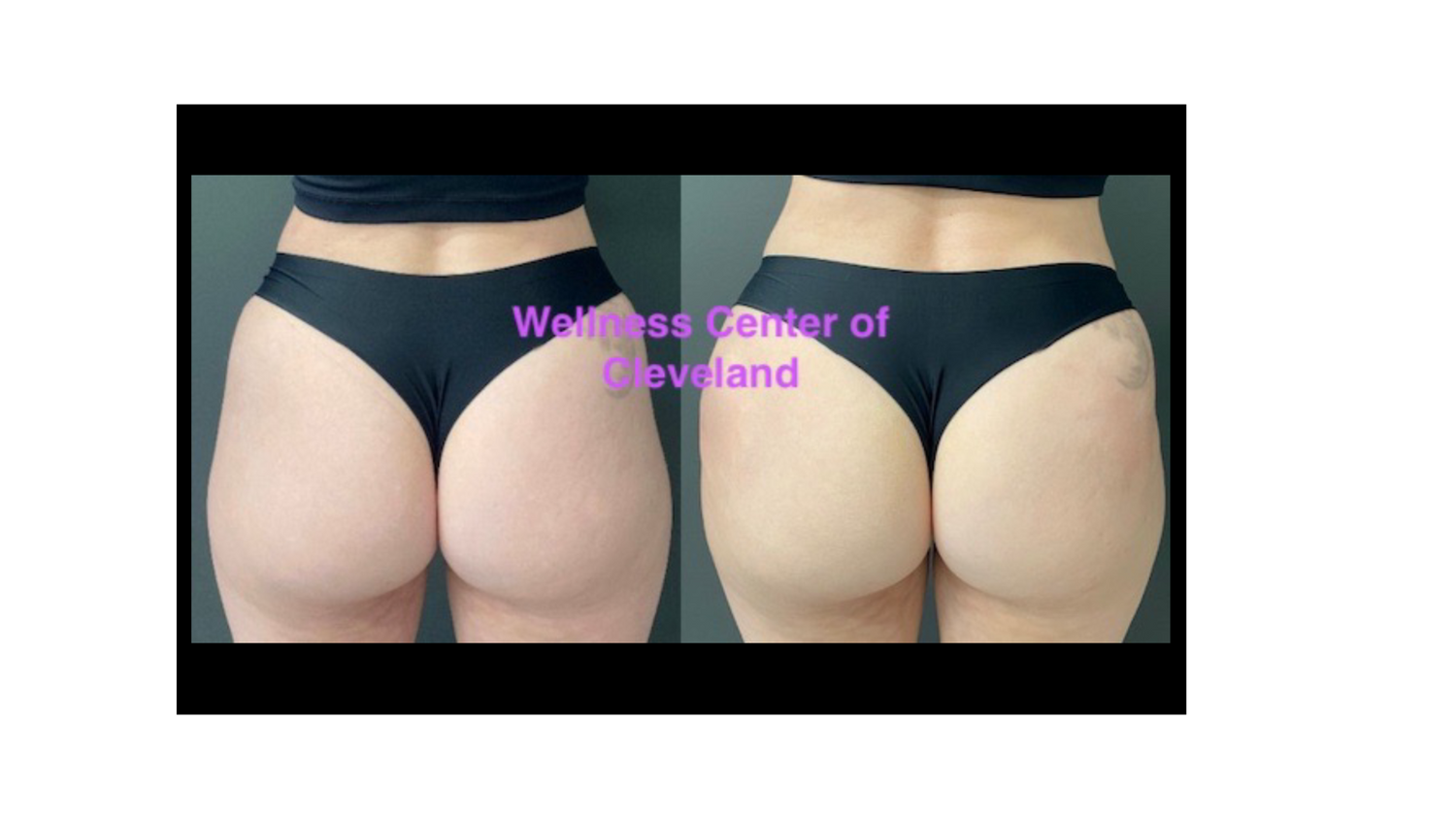 Sculptra BBL Before & After