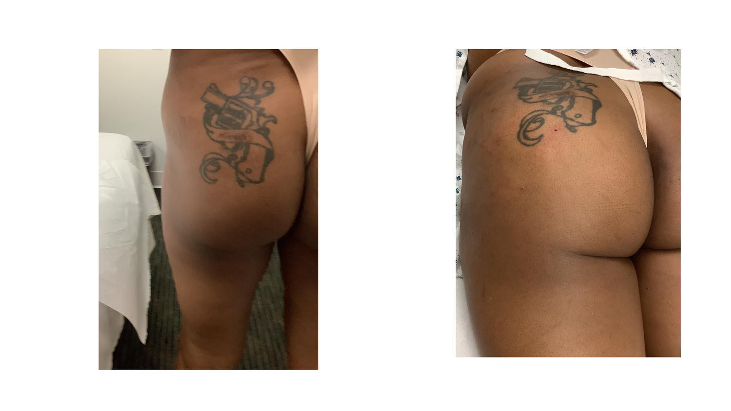 Sculptra BBL Before & After