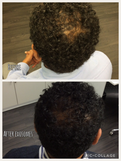 Hair Restoration Before & After