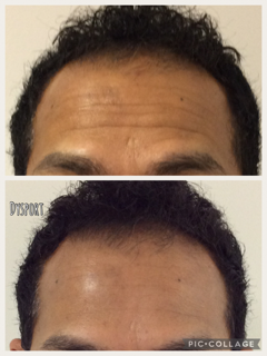 Neurotoxin Before & After